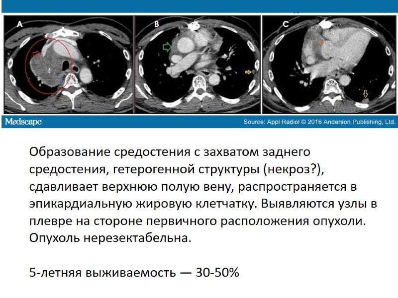 Образование средостения с захватом заднего средостения, гетерогенной структуры (некроз?), сдавливает верхнюю полую вену, распространяется